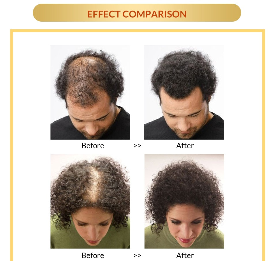 OMY LADY Anti Hair Loss Hair Growth Spray Essential Oil Liquid For Men Women Dry Hair Regeneration Repair Hair Loss Products